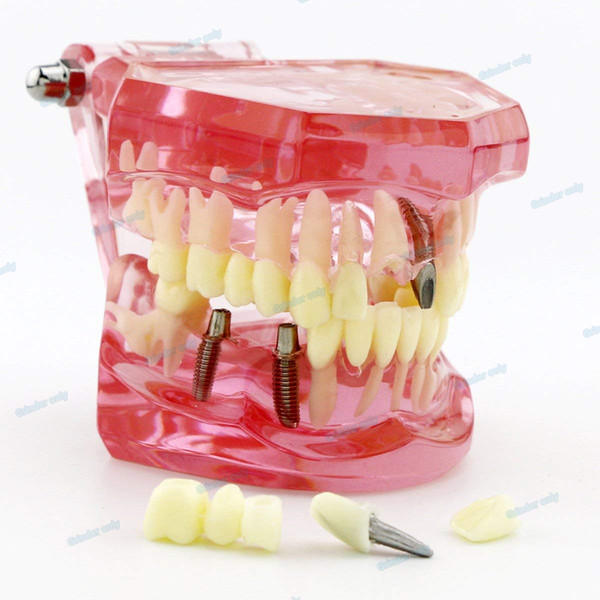 Dental Implant Teeth Model Study Teach Standard Model with with Restoration Pink