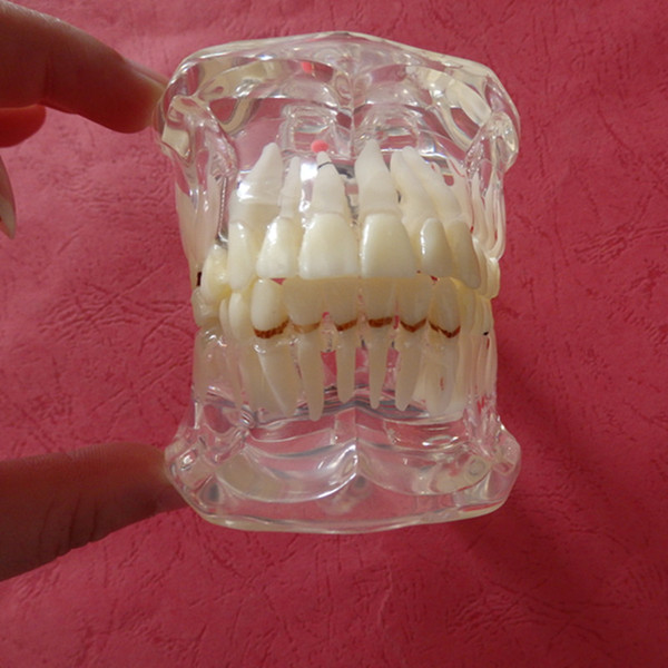 Dental Model Teeth Pathology Model With Half Implant Show Clearly the Original Shape and the Whole Structure